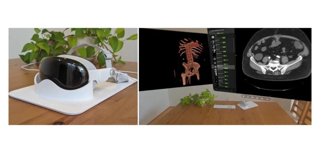 Apple vision pro en radiologie : résultats prometteurs